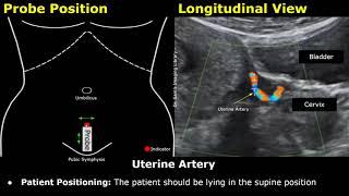 How To Scan The Uterine Artery  Doppler Ultrasound Probe Positioning  Transducer Placement USG [upl. by Pedroza877]