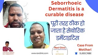 Seborrhoeic Dermatitis Got cured 100  in Online Patient with Homeopathy [upl. by Abbub]