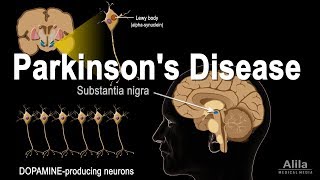 Parkinsons Disease Animation [upl. by Virgel245]