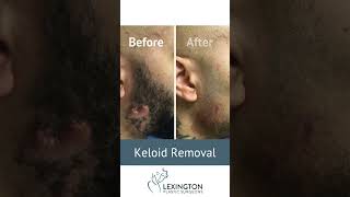 Keloid Removal Before and After [upl. by Ardnosal]