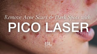 Pico Laser The Solution for Acne Scars Dark Spots amp Enlarged Pores [upl. by Ful]