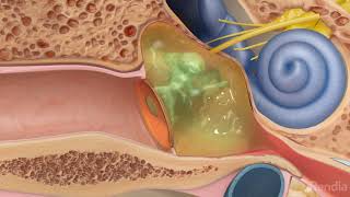 Ruptured eardrum perforated eardrumTreatment for eardrum rupture [upl. by Adnorrehs25]