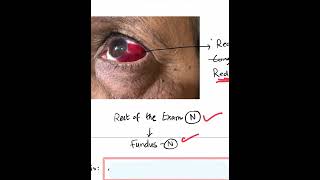 SubConjunctival Hemorrhage SCH  Case Discussion In A Minute Shorts [upl. by Klemm]