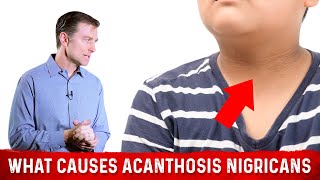 What Causes Acanthosis Nigricans Darkened Skin Folds – Dr Berg [upl. by Nellda]