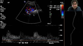 Fibromuscular Dysplasia [upl. by Edac]