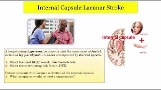 12DaysinMarch Stroke Localization Lacunar Infarcts Part 2 of 3 for the USMLE Step One Exam [upl. by Ylahtan466]