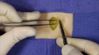 Fascial Plication Suture [upl. by Aihsile]