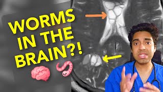 Worms in the BRAIN 🧠🪱 Doctor explains neurocysticercosis from undercooked pork 🐖 [upl. by Nnylyar190]