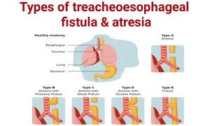 Types of treacheoesophageal fistula amp Atresia ll TEF ll pediatrics ll medical education [upl. by Enirrok]