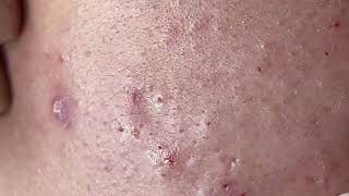 Blackhead  Acne Treatment Mai Ngoc [upl. by Padegs]