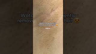 Smooth Skin Journey From Hairy to Hairless in 30 Days Rxmoore IPL Hair Removal hairremoval [upl. by Beth472]