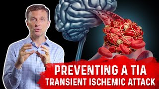 How To Prevent TIA Transient Ischemic Attack MiniStroke – DrBerg [upl. by Cazzie391]