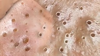 Deep Big Removal Of Blackheads Ear Nose [upl. by Hiamerej]