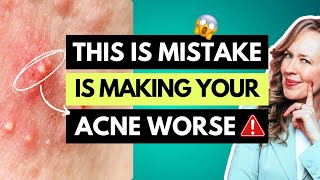 How to clear acne naturally  AVOID THIS BIG MISTAKE [upl. by Trocki]