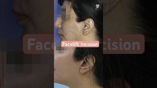 Facelift Incisions  Facelift Surgery Before After  Facelift Surgery in Hindi  SB Aesthetics [upl. by Nitsej]