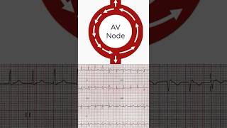 AVNRT ECG [upl. by Nylaehs95]