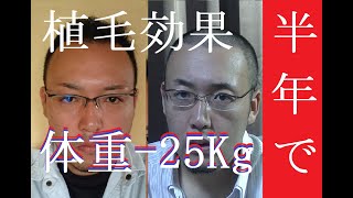 植毛で薄毛革命！第８回 ダイエット効果と禁煙効果・病院の選び方など [upl. by Louth]