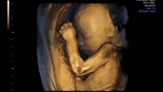 3D ultrasound 25 weeks 4D view of baby 25 week pregnancy baby girl first view [upl. by Atselec]