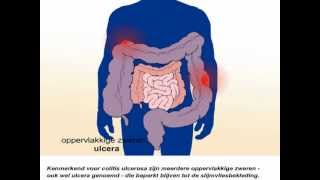 Colitis ulcerosa  Wat zijn de symptomen en behandeling van colitis ulcerosa [upl. by Julio973]