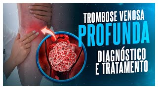 TROMBOSE VENOSA PROFUNDA  DIAGNÓSTICO E TRATAMENTO [upl. by Ennoval643]