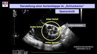 Aortenklappe im quotSchluckechoquot TEE [upl. by Notxam]