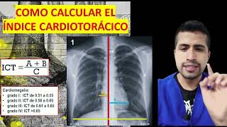 INDICE cardiotorácico Cardiomegalia [upl. by Cartwell43]