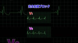 完全右脚ブロックについてまとめました！ 心電図 看護師 [upl. by Fronia]