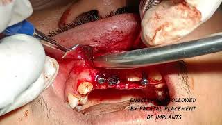 ENUCLEATION  IMPLANTS GBR  GTR [upl. by Sorazal20]