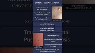 Erythema Toxicum Neonatorum vs Transient Neonatal Pustular Melanosis [upl. by Stormie]