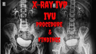 XRAY IVP  XRAY IVU Procedure Indications Findings  Intravenous Urogram  Intravenous Pyelogram [upl. by Ferro]