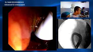 ercp for sems obstruction [upl. by Aelyk85]