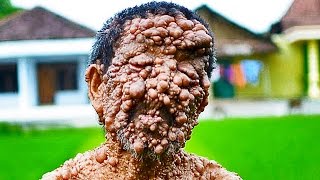 Trypophobia Lovers  5 Weird Skin Conditions [upl. by Emmet]