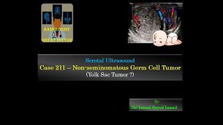 Ultrasound Case 211  NonSeminomatous Germ Cell Tumor [upl. by Puiia]