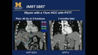 SRSSBRT  Prostate Pancreas amp Liver  By M Matuszak PhD amp M Feng MD [upl. by Nnaegroeg]