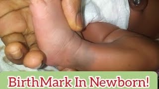 quot👶💕 BirthMarks in Newborns What You Need to Know for Your Babys Health 🤱‍♀️👶quot [upl. by Cirtemed184]