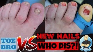 CAUSE OF AND CURE FOR THICK TOENAILS  FULL EXPLANATION amp TREATMENT [upl. by Saito]