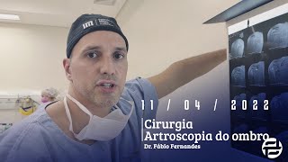 2ª Cirurgia do Dia Artroscopia de ombro Procedimento de Acromioplastia Paciente com Lesão parcial [upl. by Annerol]