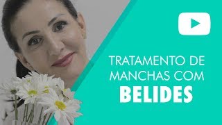 Tratamento de manchas com BELIDES [upl. by Iturk]