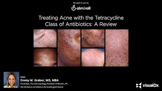 Treating Acne with the Tetracycline Class of Antibiotics A Review [upl. by Shelden]