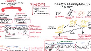 Asthma  signs and symptoms pathophysiology [upl. by Allrud380]