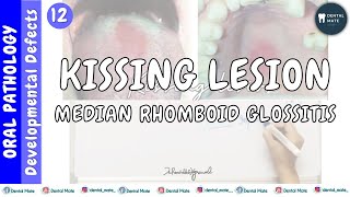 Median rhomboid glossitis  Kissing lesion  Central papillary atrophy  Dr Paridhi Agrawal [upl. by Dominique]