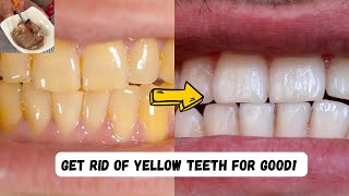 Get Rid Of YELLOW TEETH For GOOD [upl. by Sorenson]