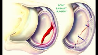 Acute Bankart Fracture Treatment with Endobutton [upl. by Mairhpe]