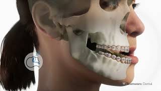 Orthognathic Surgery Underbite [upl. by Unam]