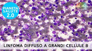 Nuove Speranze nel Trattamento del Linfoma Diffuso a Grandi Cellule B EMA approva Tafasitamab [upl. by Annait]