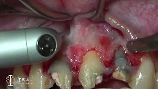 Recession Coverage via Soft Tissue Substitute Frenectomy amp Apicoectomy in Aesthetic Zone III [upl. by Amiarom]