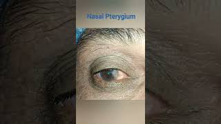 what causes a pterygium  pterygium vs pinguecula [upl. by Akemal883]