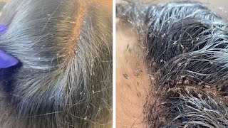 Hair Clinic Remove Hundreds Of Lice From Clients Head [upl. by Claudy]