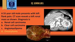 Renal oncocytoma central stellate scar [upl. by Taber]