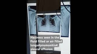 cxr radiological ground glass opacity or haziness seen in condition like pneumonitis or plueral e [upl. by Nodnarb]